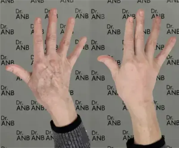 Boyun & El Gençleştirme before-after 1