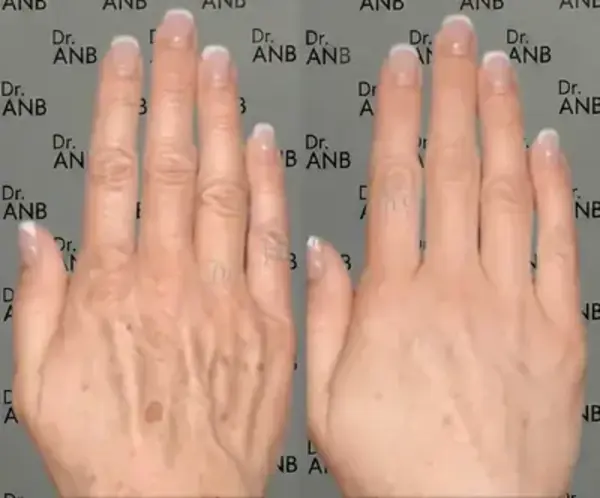 Boyun & El Gençleştirme before-after 2