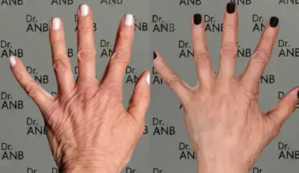 Boyun & El Gençleştirme before-after 3