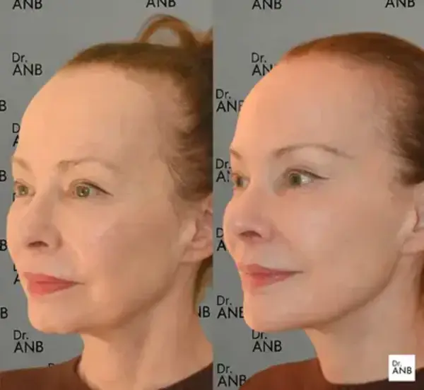 Gençlik ve Nem Uygulamaları before-after 2