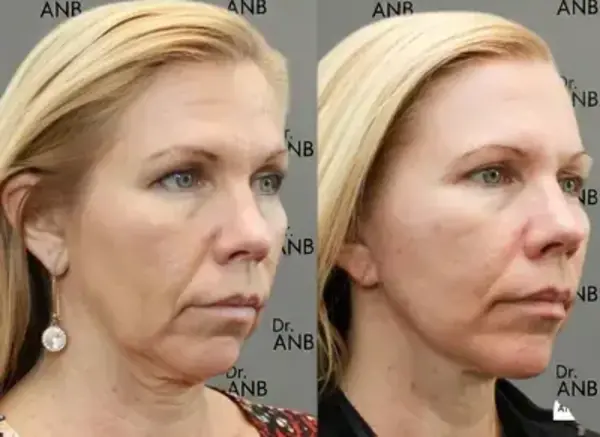 Gençlik ve Nem Uygulamaları before-after 3