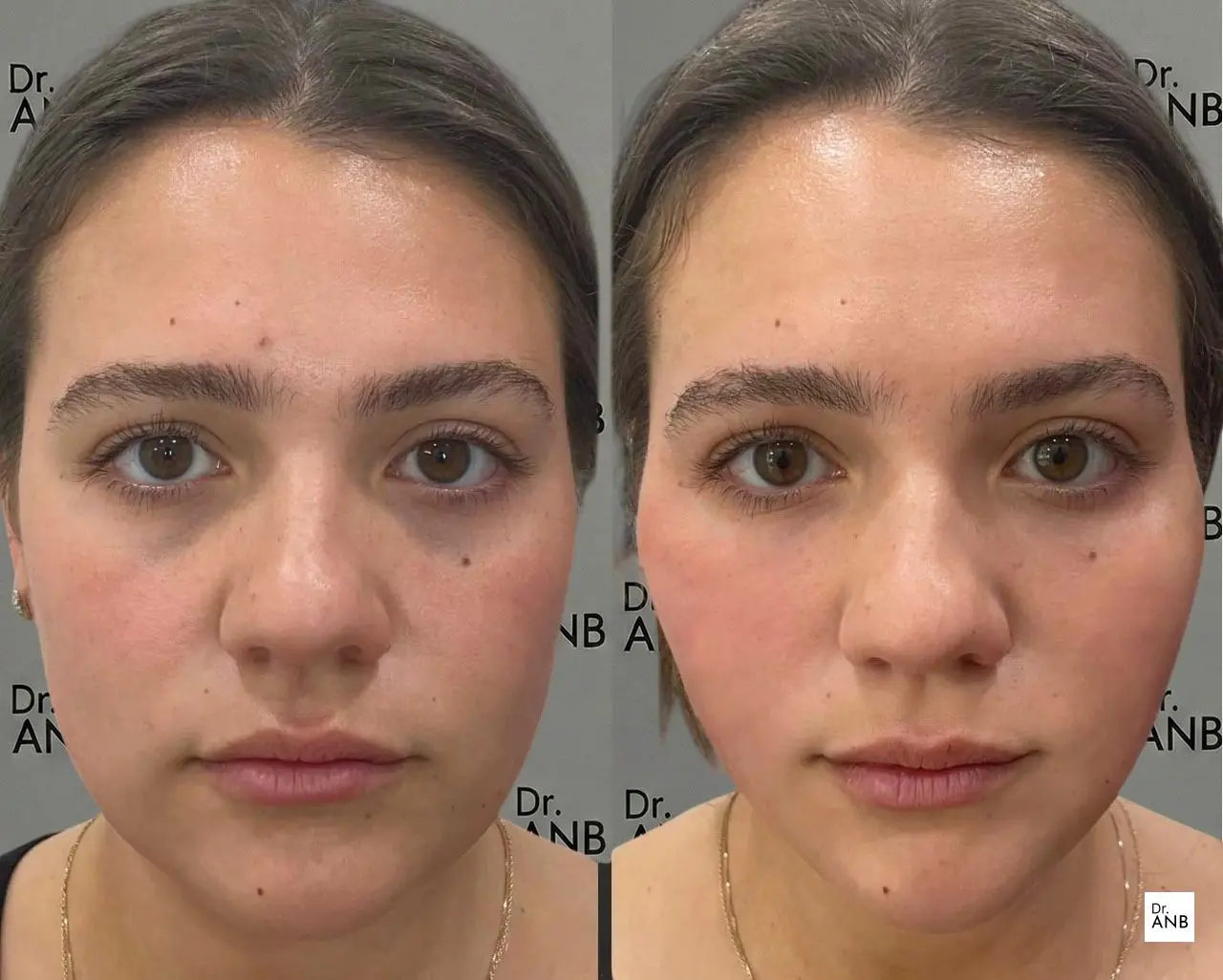 Fransız Askısı - Mutlu Danışan