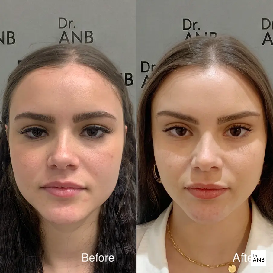 Fransız Askısı - Mutlu Danışan